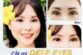 Cắt Mí Sâu Tây Giờ Phải Hạ Size Mí – Đâu Là Nếp Mí Phù Hợp Với Khuôn Mặt Bạn?