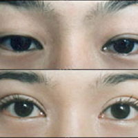 5 Cách chữa mắt sụp mí không phẫu thuật hiệu quả