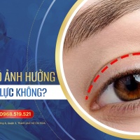Cắt mí mắt có ảnh hưởng đến thị lực không?