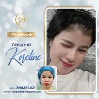 Nâng mũi bị bóng đỏ đầu mũi: coi chừng biến chứng nếu chủ quan