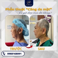 Phẫu Thuật Căng Da Mặt Có Giữ Được Trọn Đời Không? Vì Sao Nhiều Người Vẫn Chọn?