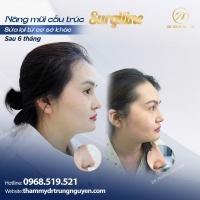 Tuổi thọ của nâng mũi là bao lâu? 7 cách để kéo dài tuổi thọ của nâng mũi