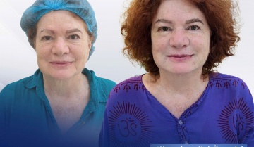 Căng Chỉ Collagen Bao Lâu Trở Lại Bình Thường Và Khi Nào Đẹp Tự Nhiên?