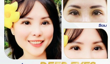 Cắt Mí Sâu Tây Giờ Phải Hạ Size Mí – Đâu Là Nếp Mí Phù Hợp Với Khuôn Mặt Bạn?