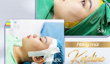 7 Lưu Ý Chăm Sóc Sau Nâng Mũi Giúp Dáng Mũi Tự Nhiên, An Toàn Lâu Dài