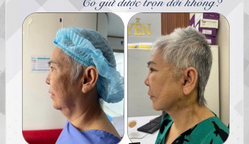 Phẫu Thuật Căng Da Mặt Có Giữ Được Trọn Đời Không? Vì Sao Nhiều Người Vẫn Chọn?