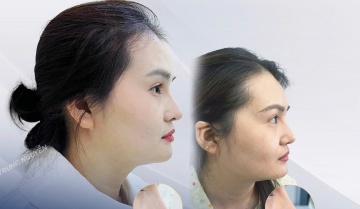 Tuổi thọ của nâng mũi là bao lâu? 7 cách để kéo dài tuổi thọ của nâng mũi