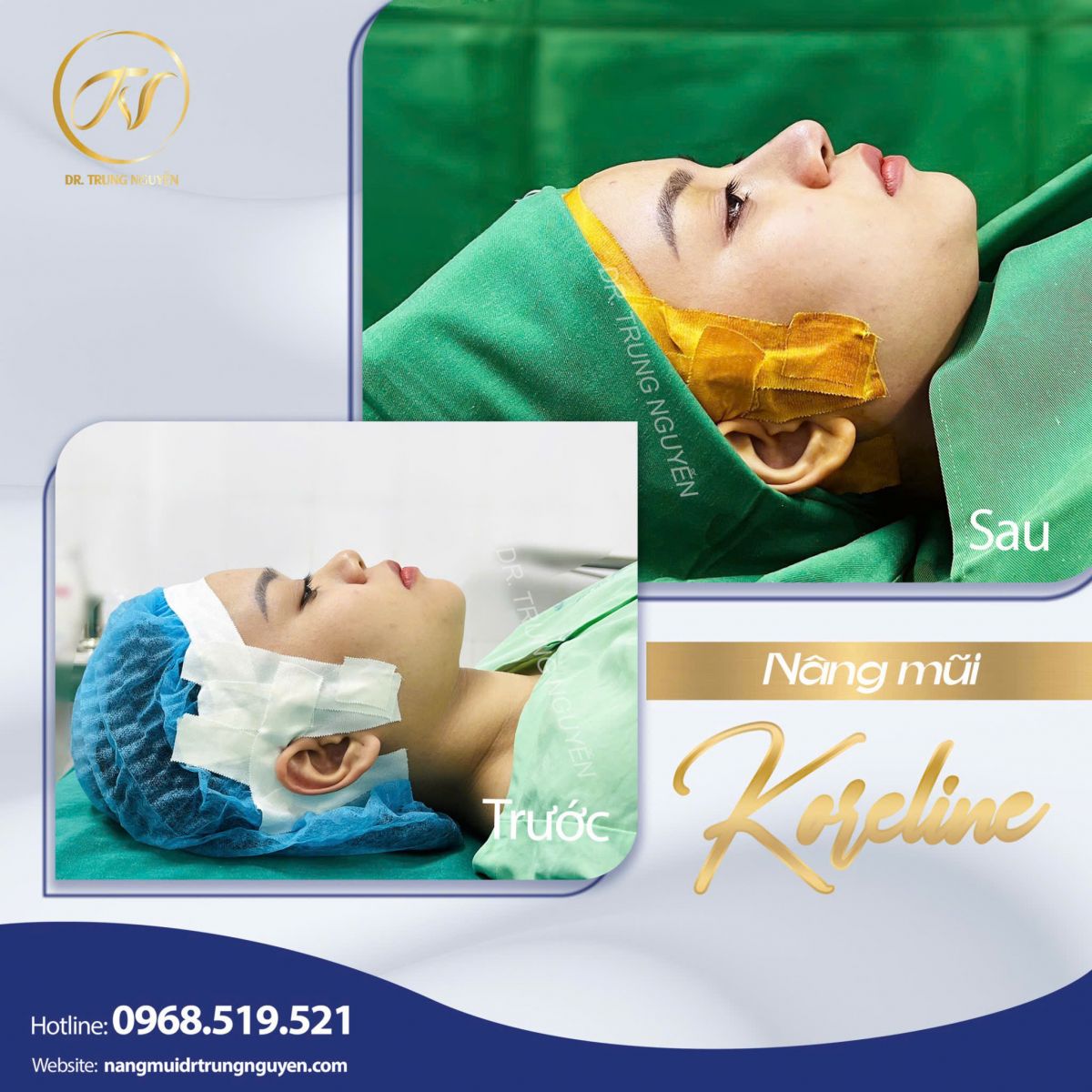 Hình ảnh minh họa 7 lưu ý quan trọng trong chăm sóc sau nâng mũi giúp mũi nhanh ổn định và giữ dáng tự nhiên.