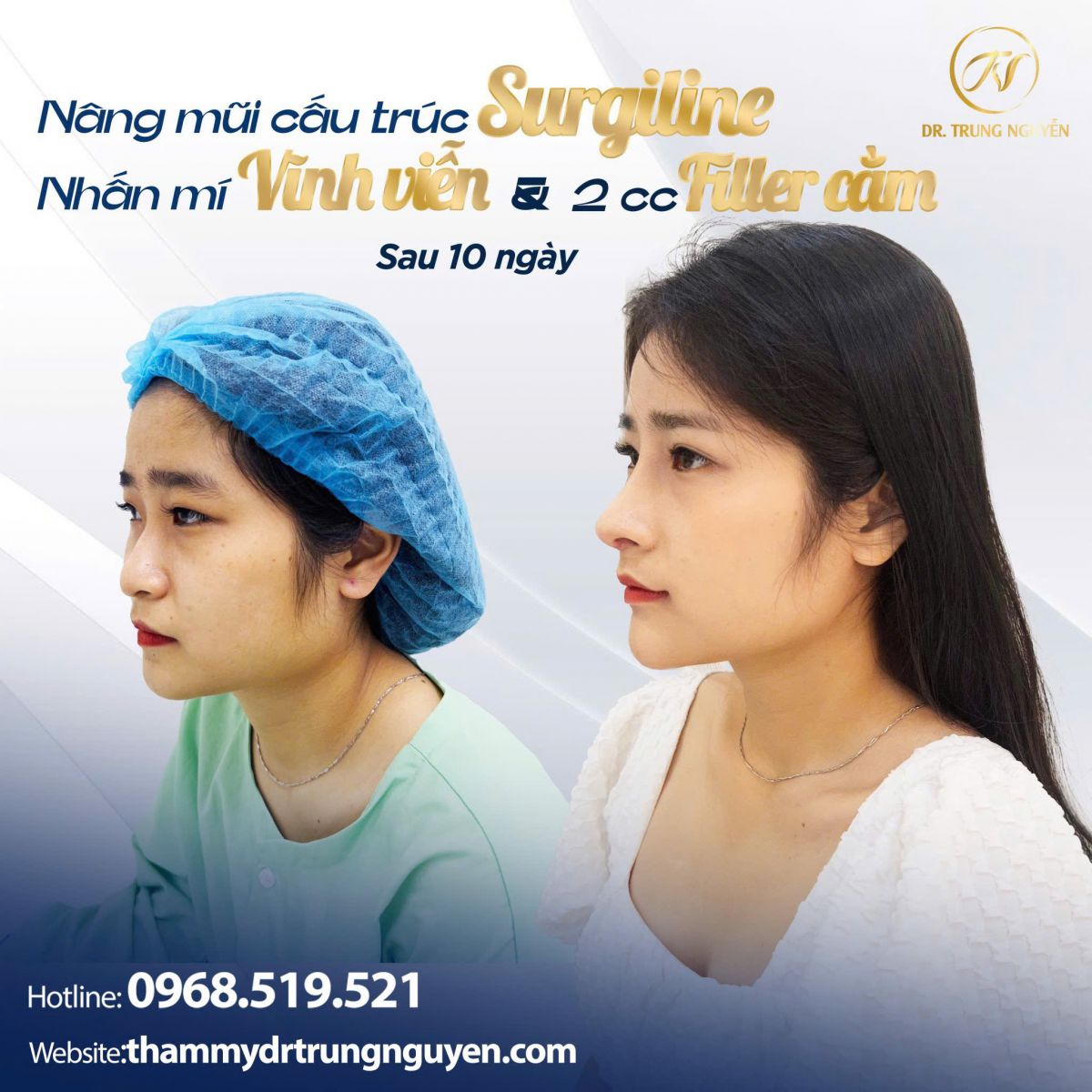 Bác sĩ Trung Nguyễn – người trực tiếp thực hiện và theo dõi tuổi thọ nâng mũi lâu dài