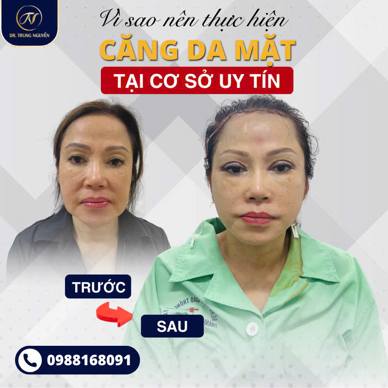 Tay nghề bác sĩ và quy trình đạt chuẩn y khoa là yếu tố quyết định thành công của phẫu thuật căng da mặt.