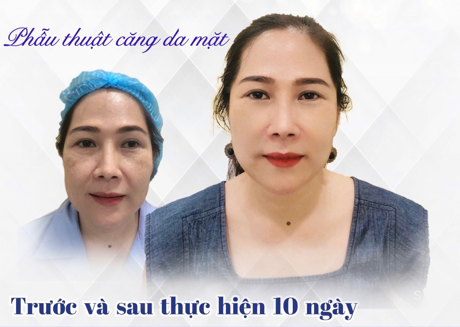 Bác sĩ Trung Nguyễn với nhiều năm kinh nghiệm trong phẫu thuật căng da mặt chuyên sâu