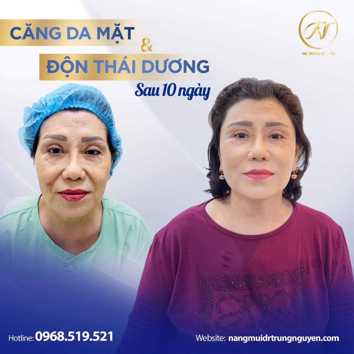 Thời gian hồi phục sau căng chỉ collagen thường từ 3 đến 8 tuần tùy cơ địa