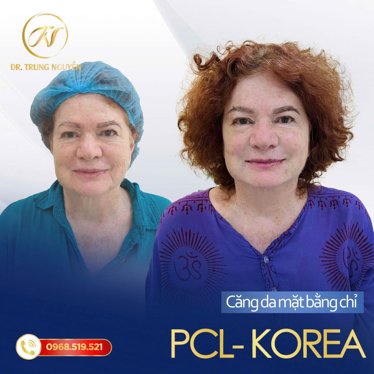 Căng chỉ collagen 6D Mushup – giải pháp trẻ hóa da không phẫu thuật tại Dr. Trung Nguyễn