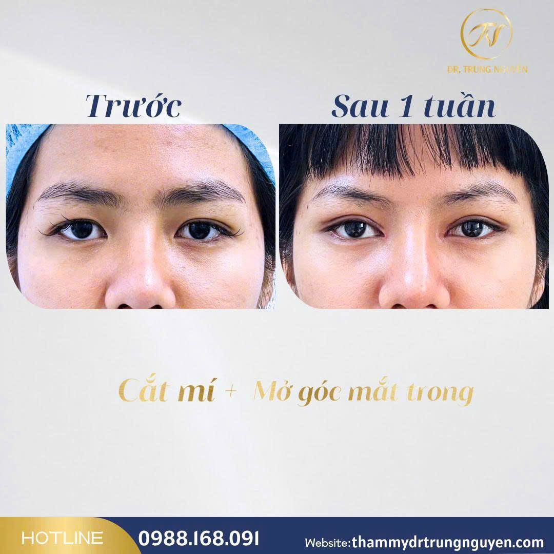 Bác sĩ Trung Nguyễn trực tiếp thăm khám và tư vấn giải pháp hạ size mí phù hợp cho từng khuôn mặt.