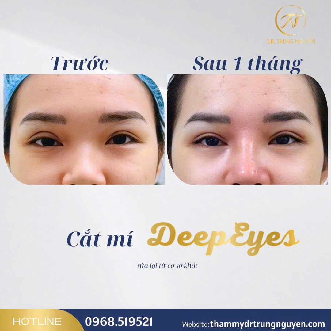 Bác sĩ Trung Nguyễn trực tiếp thăm khám và tư vấn giải pháp hạ size mí phù hợp cho từng khuôn mặt.