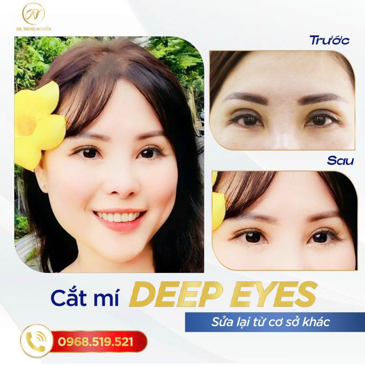 Hạ size mí giúp điều chỉnh nếp mí sâu Tây về form tự nhiên, hạn chế hốc mắt sâu và giữ nét hài hòa cho khuôn mặt.