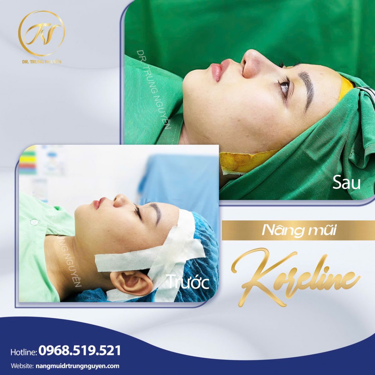 Chăm sóc hậu phẫu đúng cách là yếu tố quan trọng giúp dáng mũi ổn định và tự nhiên lâu dài.