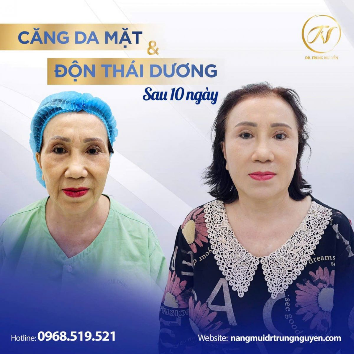 Căng chỉ collagen tác động trực tiếp vào cấu trúc nâng đỡ da, giúp da săn chắc tự nhiên