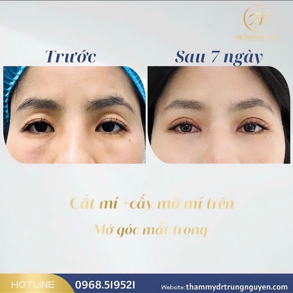 Kỹ thuật Deepeyes tập trung hạ size mí một cách tinh tế, cá nhân hóa theo cấu trúc mắt tại Dr. Trung Nguyễn.