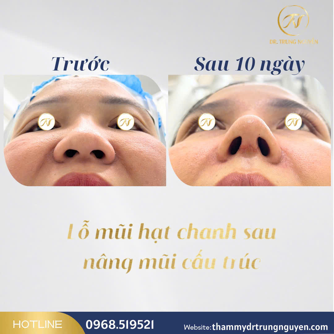 Cá nhân hóa dáng mũi là yếu tố quyết định hiệu quả thẩm mỹ lâu dài.