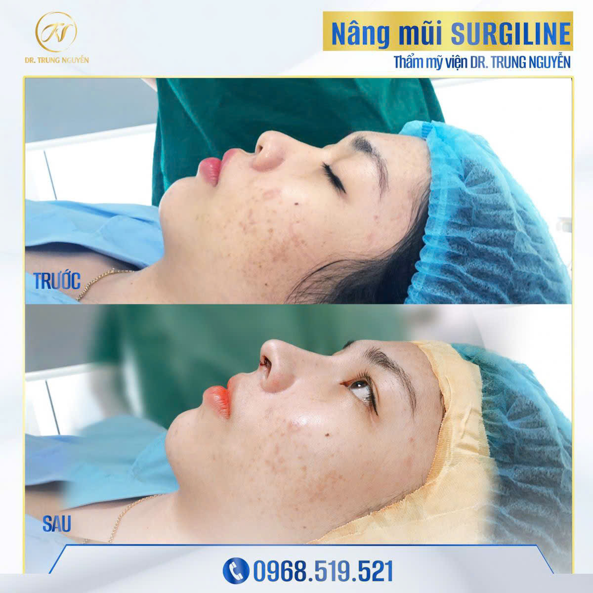 Dịch vụ nâng mũi với dáng mũi Trung Hoa Tại Dr Trung Nguyễn Tp. HCM