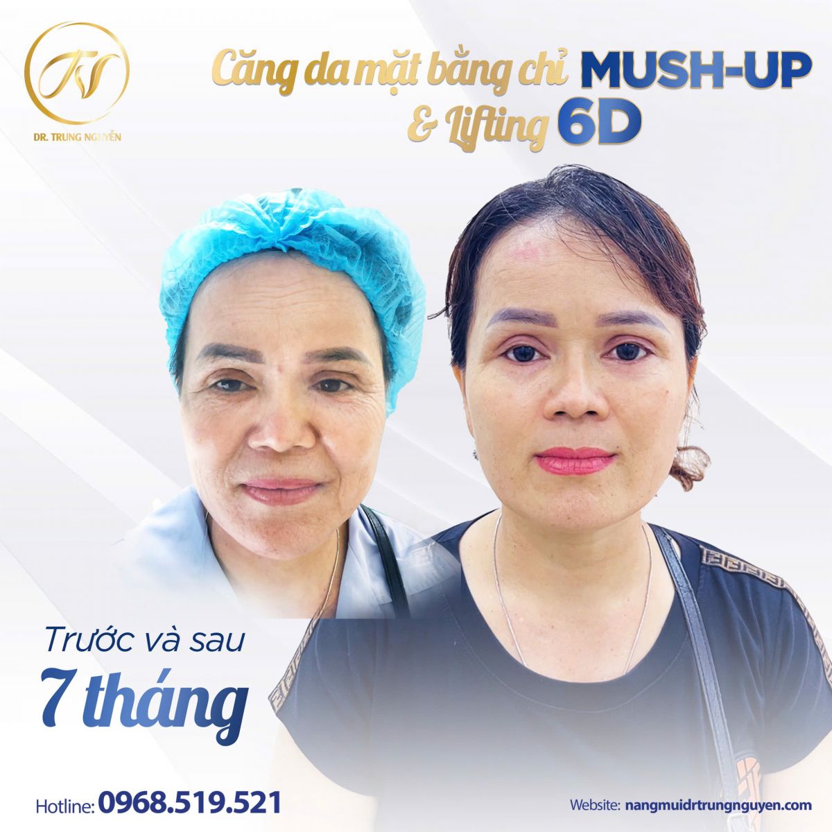 Kết quả sau căng chỉ collagen 6D Mushup: làn da săn chắc, đường nét gương mặt tự nhiên hơn theo thời gian