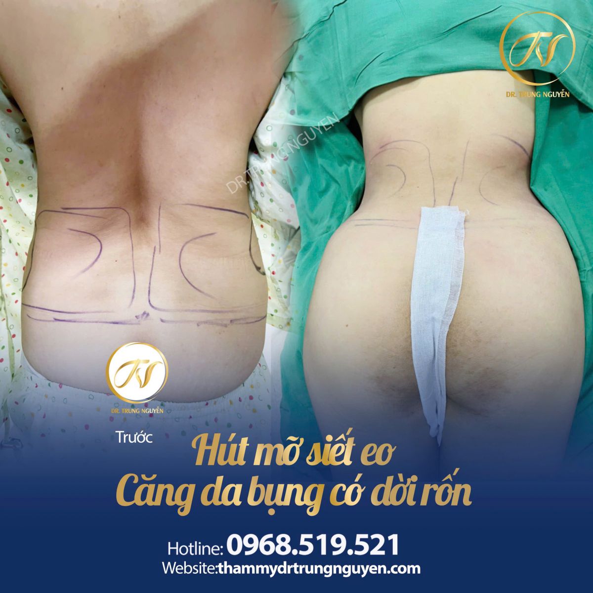 Kết quả hút mỡ bụng – Dr. Trung Nguyễn