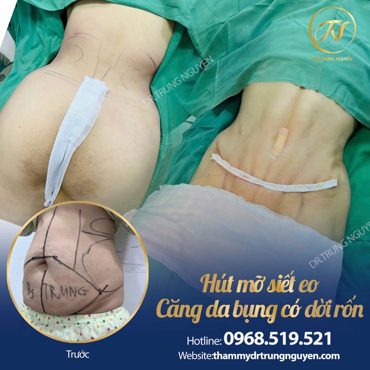 Kết quả hút mỡ bụng – Dr. Trung Nguyễn