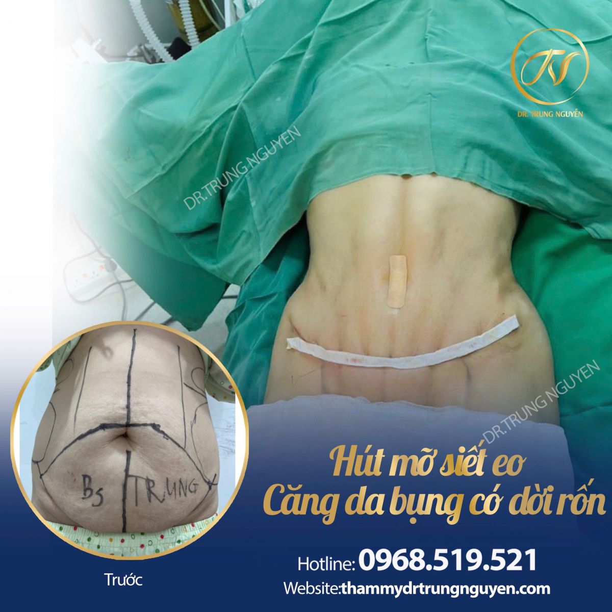 Kết quả hút mỡ bụng – Dr. Trung Nguyễn