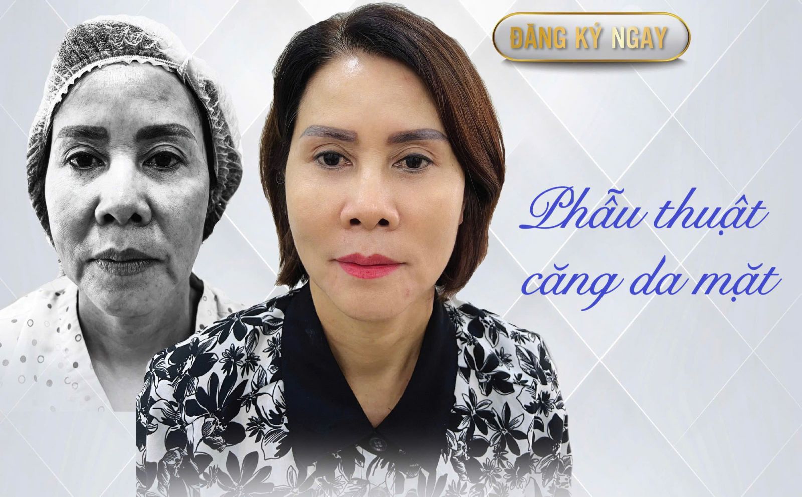 Phẫu thuật căng da mặt tác động trực tiếp vào lớp SMAS giúp trẻ hóa bền vững