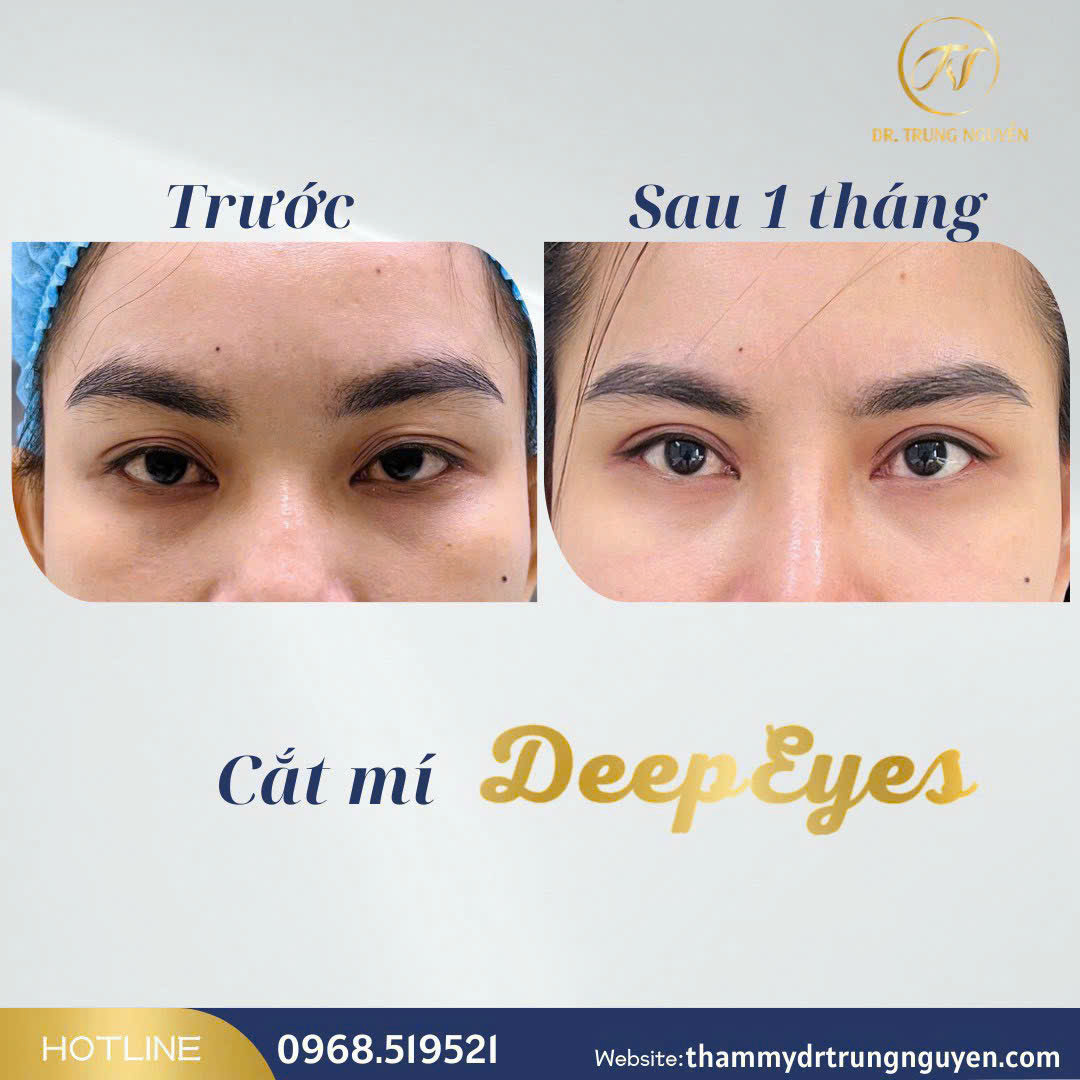 Hạ size mí đúng tỷ lệ giúp đôi mắt mềm mại hơn, cải thiện thần thái tổng thể gương mặt.