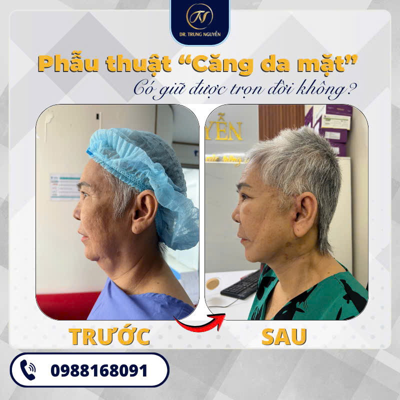 Phẫu thuật căng da mặt giúp cải thiện toàn diện tình trạng da bị lão hóa và chảy xệ