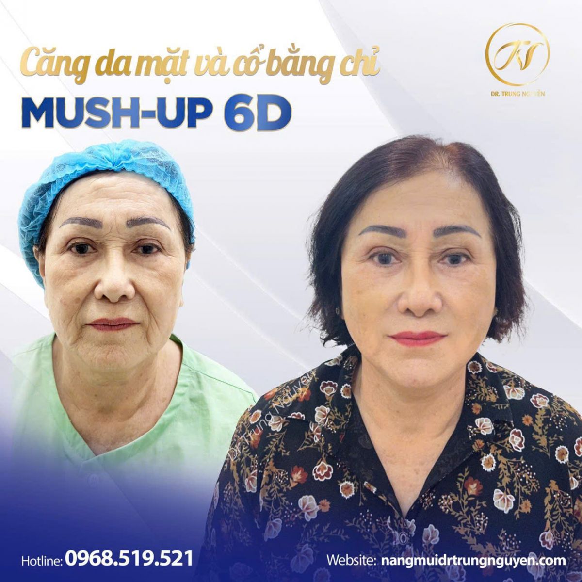 Bác sĩ Trung Nguyễn trực tiếp thăm khám và thực hiện căng chỉ collagen 6D Mushup