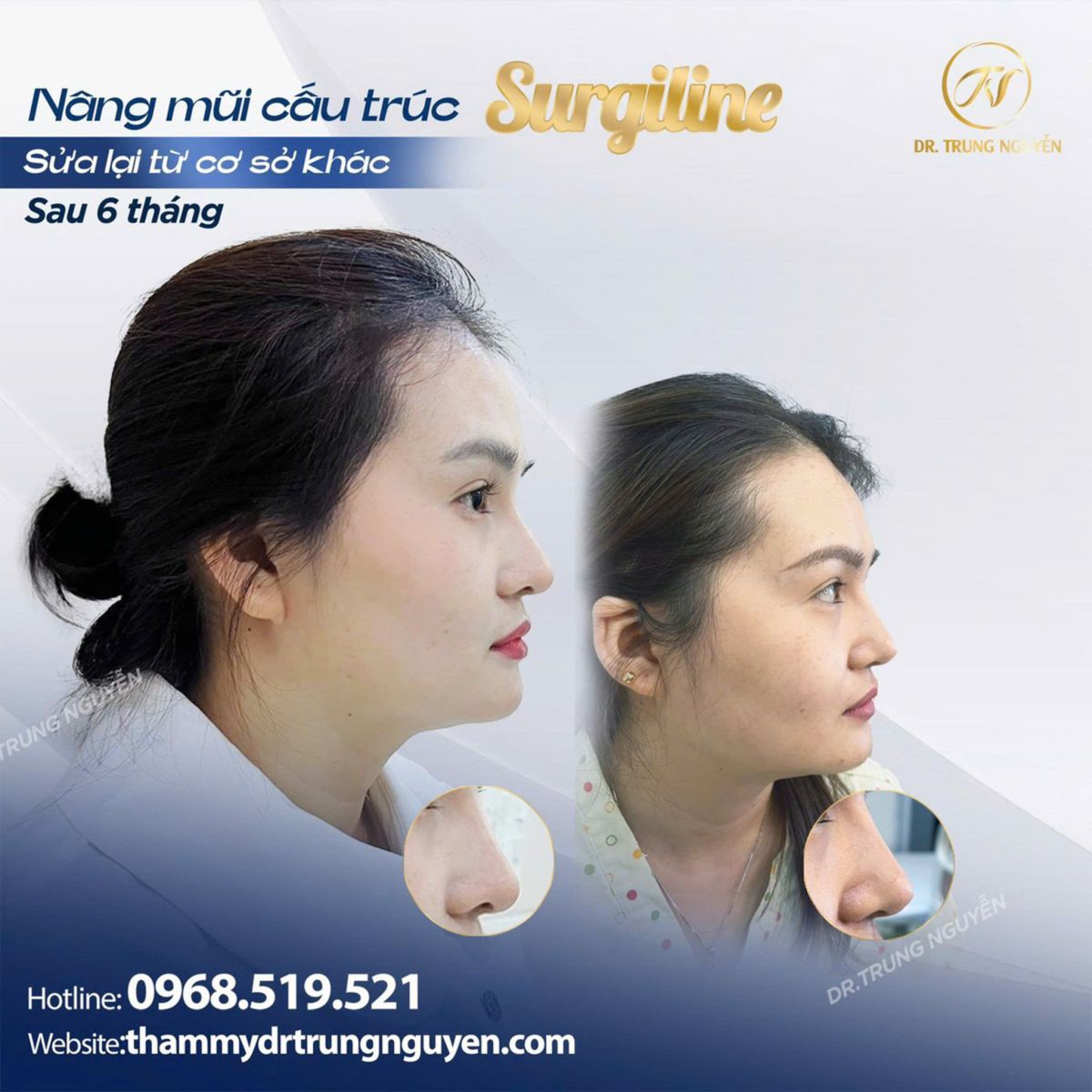 Tuổi thọ của nâng mũi phụ thuộc vào cấu trúc mũi và kỹ thuật bác sĩ