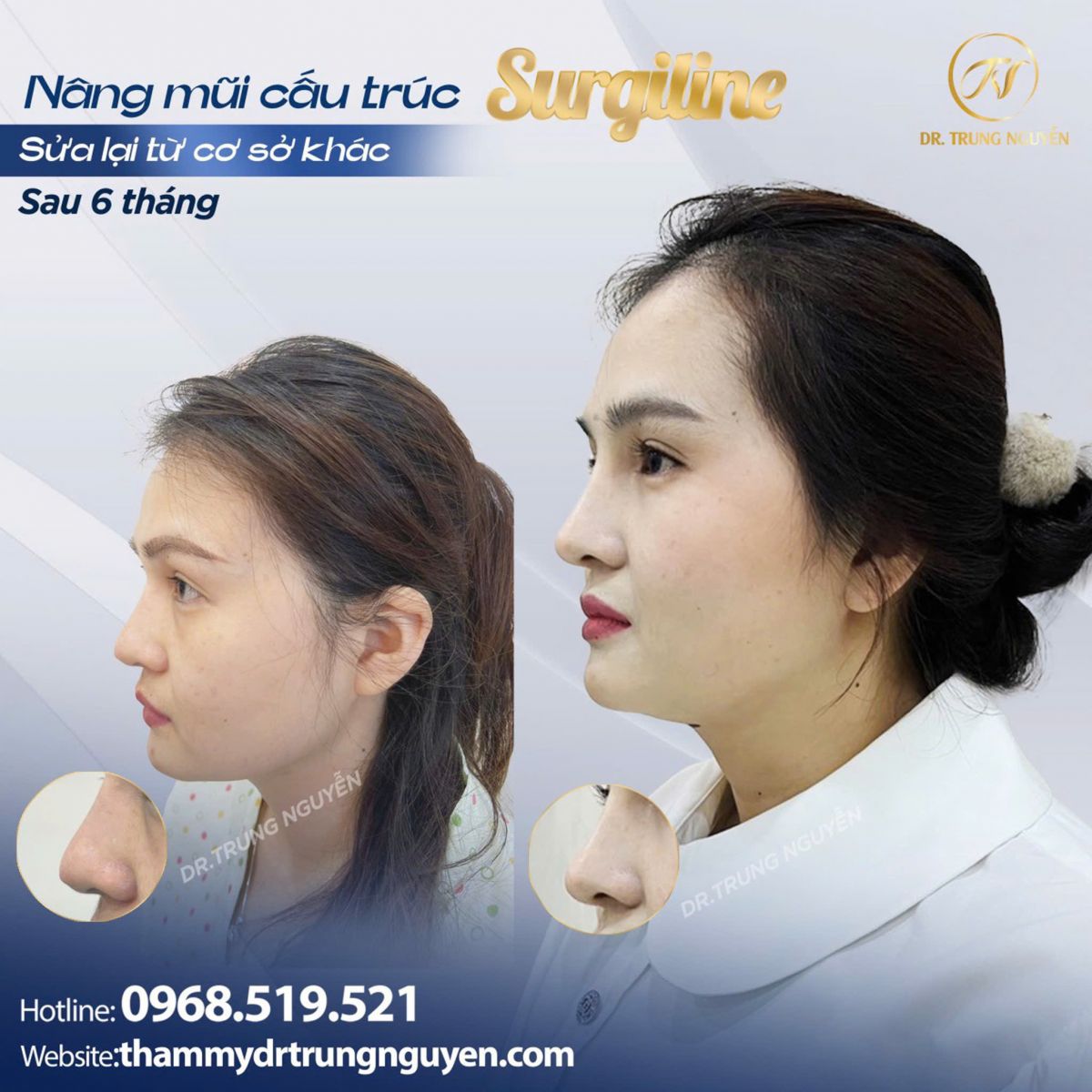 Mỗi phương pháp nâng mũi có tuổi thọ khác nhau tùy cấu trúc mũi