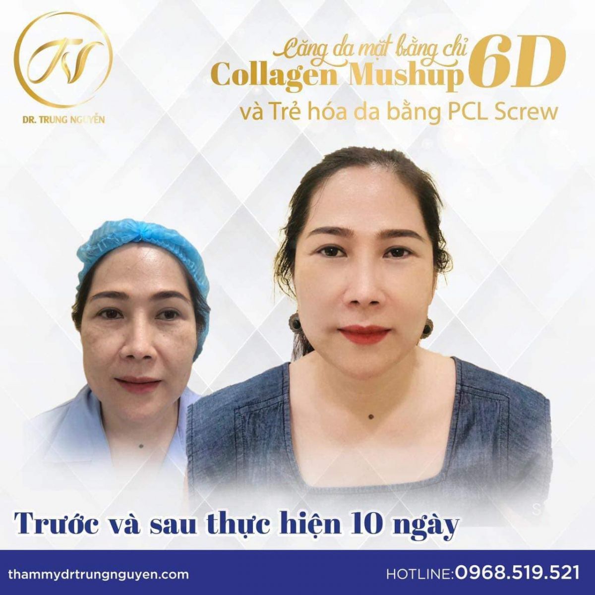 Trẻ hóa làn da cùng phương pháp PCL Screw và căng da mặt bằng chỉ Collagen Mush up 6D