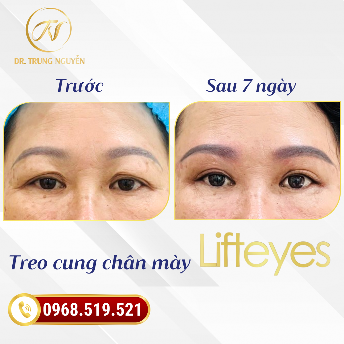 Khách hàng thực hiện treo cung chân mày Lift Eyes tại Thẩm mỹ Bác sĩ Trung Nguyễn