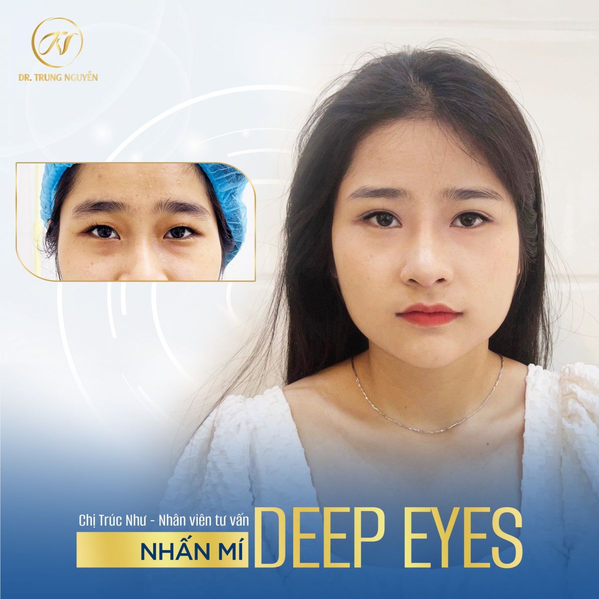 Nhấn mí Deep Eyes - Đôi mắt rạng ngời, tràn đầy sức sống