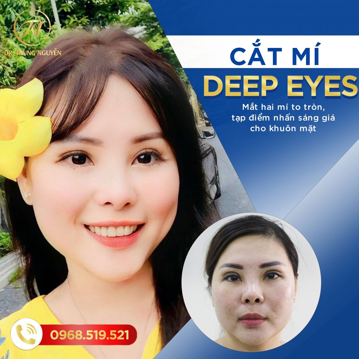 Hình ảnh khách hàng cắt mí Deep eyes tự nhiên tại Dr Trung Nguyễn