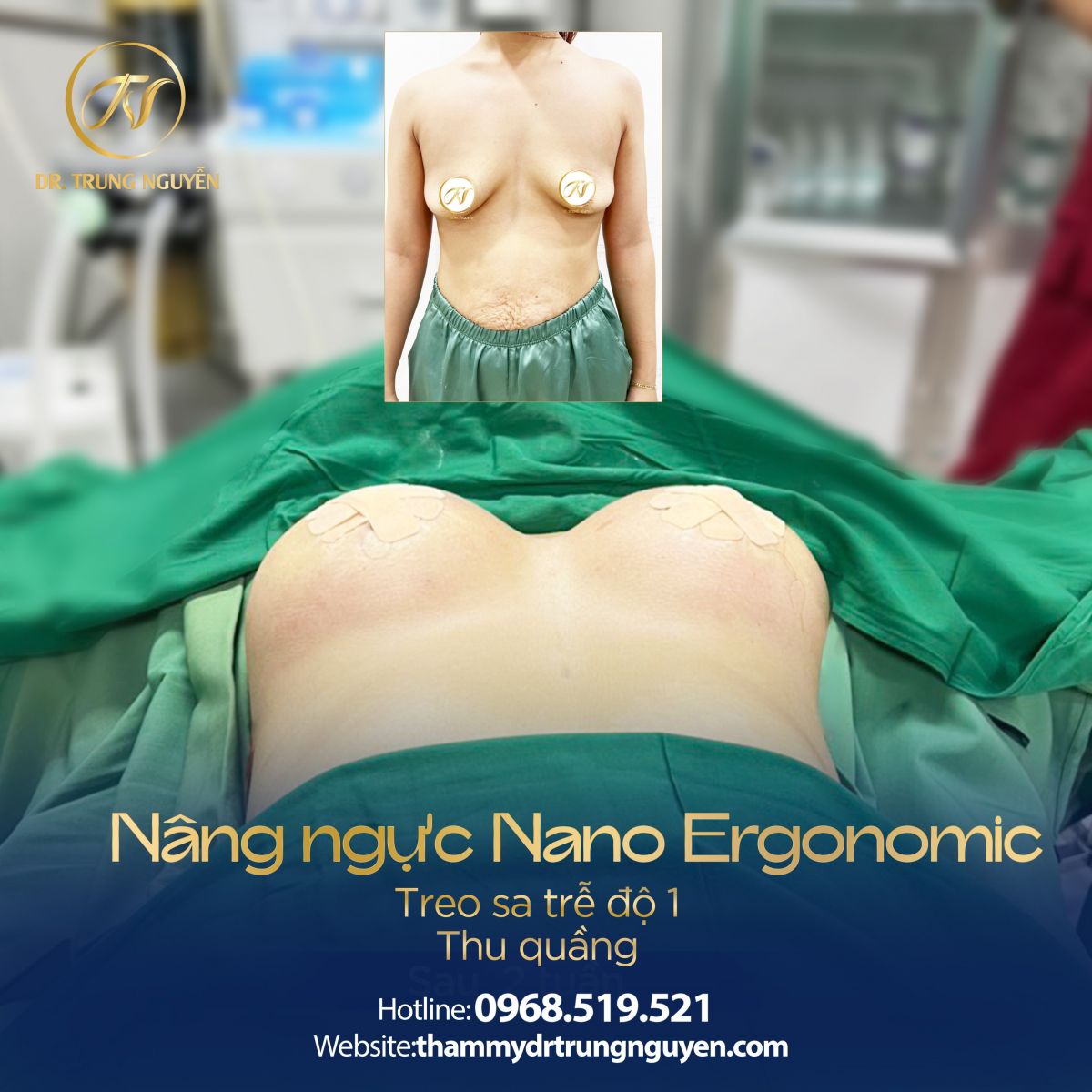 Khách hàng nâng ngực bằng phương pháp đặt túi Nano Ergonomic